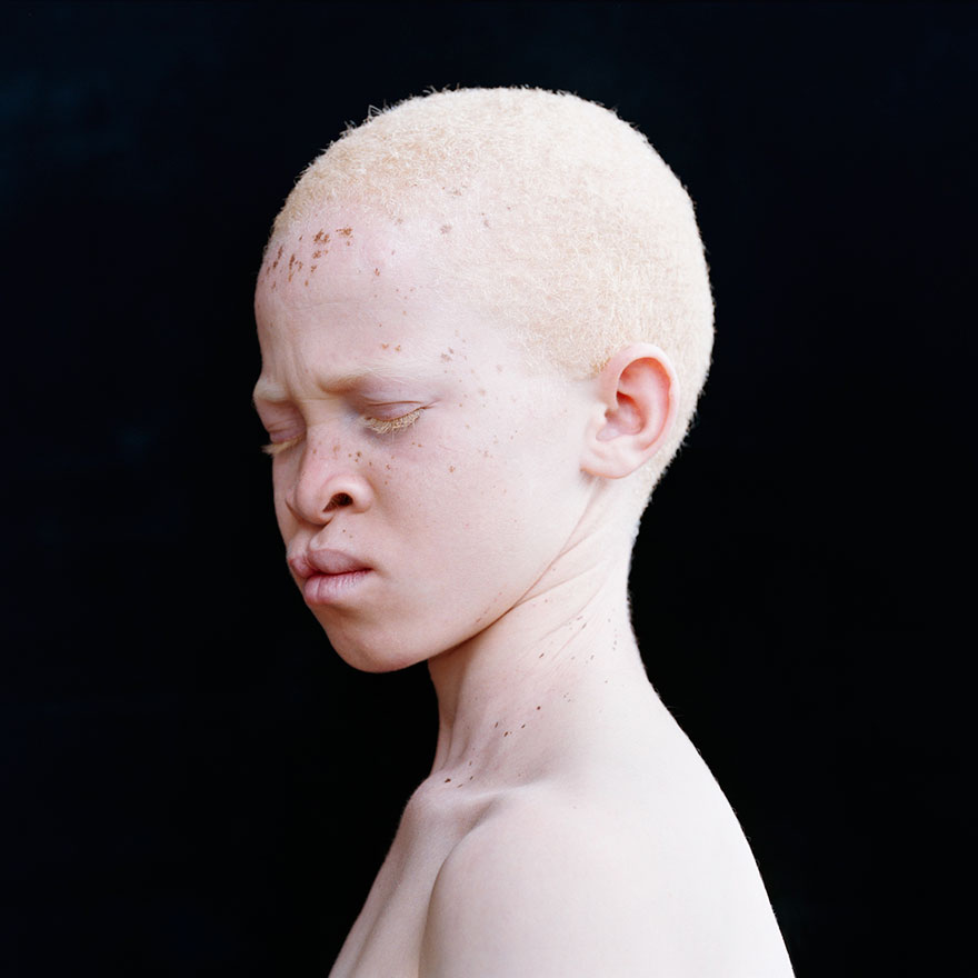 Albums 102+ Images show me a picture of an albino person Full HD, 2k, 4k