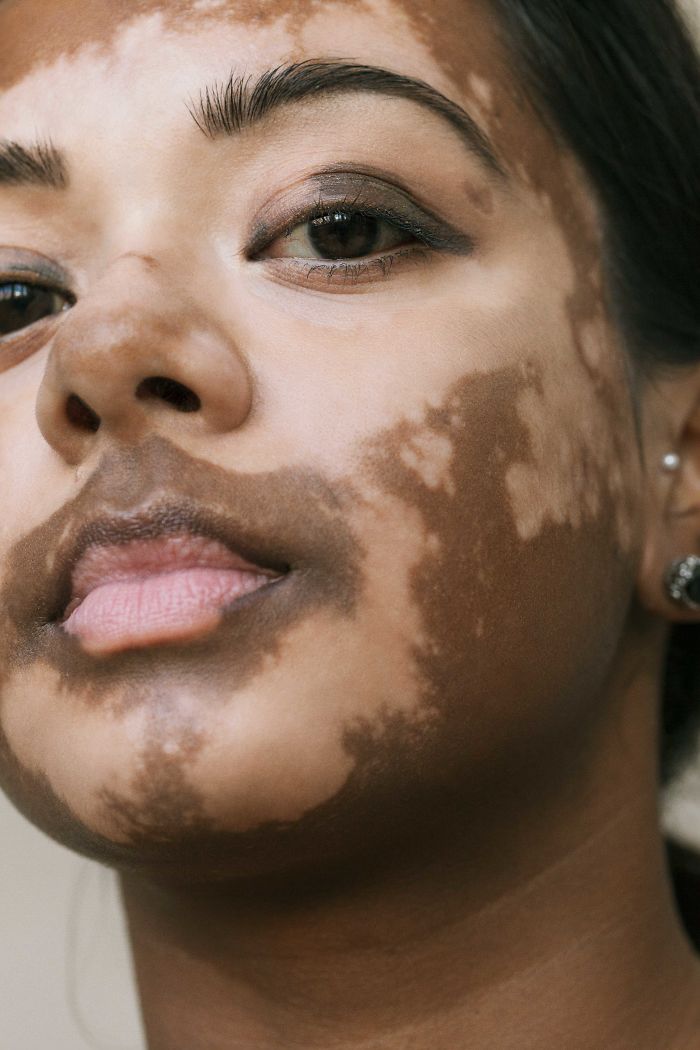 vitiligo dating service