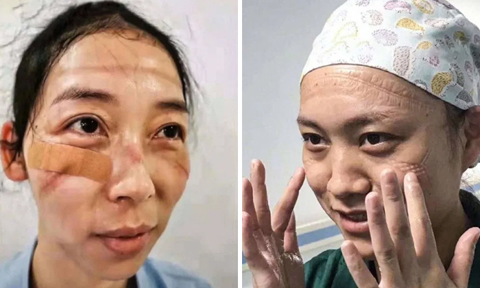 5e41144d2e120 chinese nurses face masks corona virus 5e3d37a86744d  700 - Coronavírus: Enfermeiras chinesas chamadas de heroínas ficam com feridas pelas máscaras