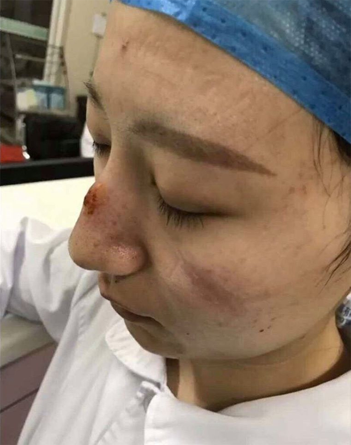5e41144db58f5 chinese nurses face masks corona virus 5e3d58124abdb  700 - Coronavírus: Enfermeiras chinesas chamadas de heroínas ficam com feridas pelas máscaras