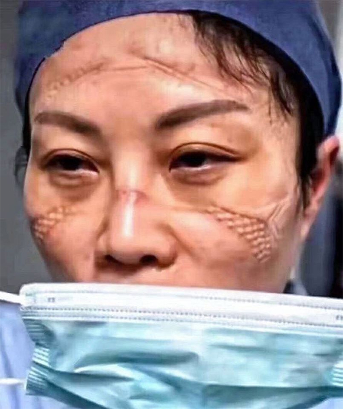5e41144e3547c chinese nurses face masks corona virus 2 5e3d2fc2cf77d  700 - Coronavírus: Enfermeiras chinesas chamadas de heroínas ficam com feridas pelas máscaras