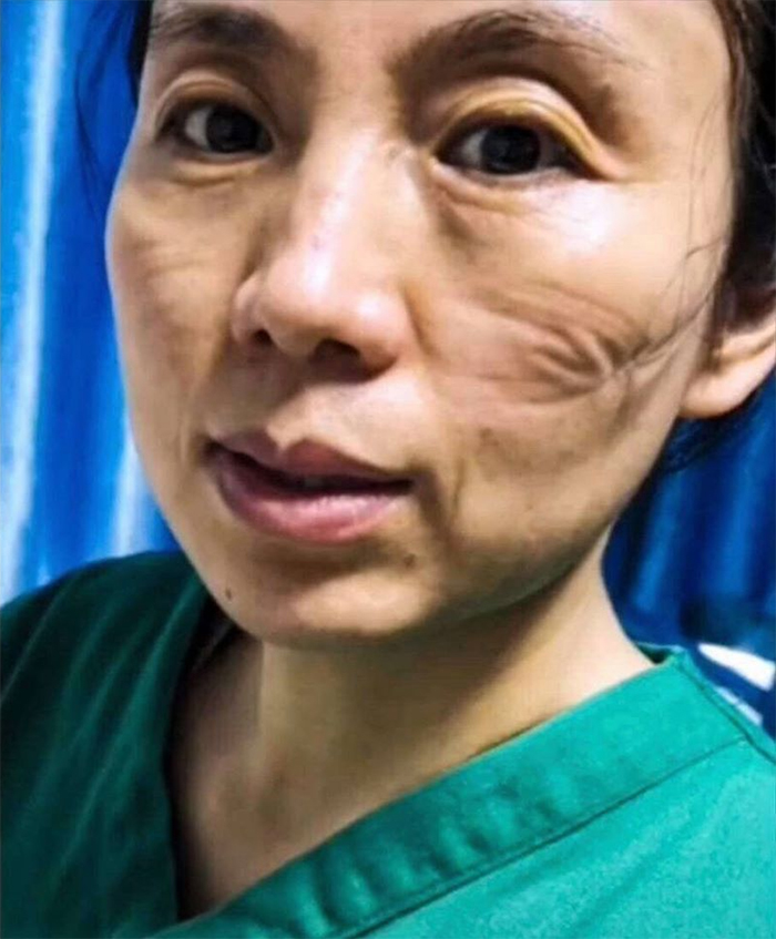 5e41144ea36d1 chinese nurses face masks corona virus 3 5e3d2fc4c99cd  700 - Coronavírus: Enfermeiras chinesas chamadas de heroínas ficam com feridas pelas máscaras