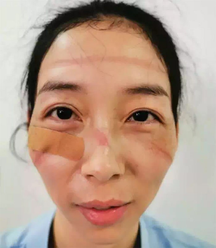 5e41144f29ad5 chinese nurses face masks corona virus 4 5e3d2fc6d2fdc  700 - Coronavírus: Enfermeiras chinesas chamadas de heroínas ficam com feridas pelas máscaras
