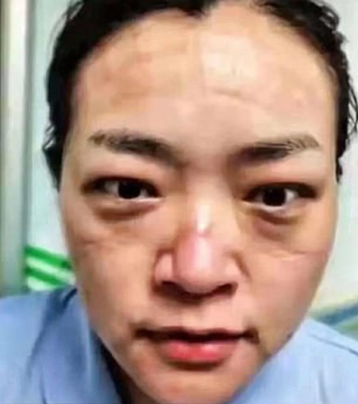 5e41144f8ecb5 chinese nurses face masks corona virus 5e3d5a0289ebc  700 - Coronavírus: Enfermeiras chinesas chamadas de heroínas ficam com feridas pelas máscaras